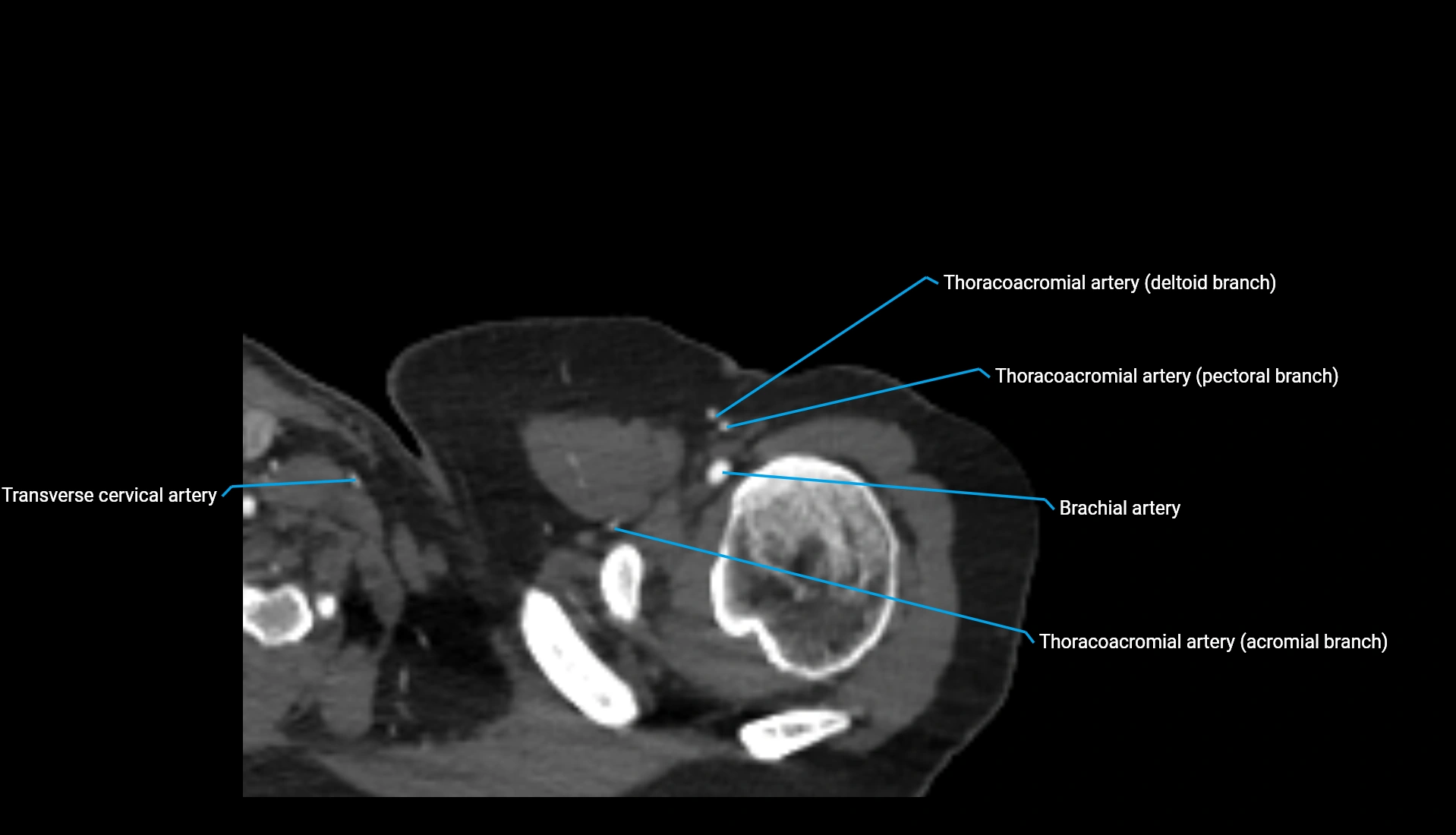 CTA upper limb axial cross sectional anatomy labelled image 322 (1).webp